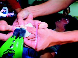 婦人戴十年前戒指卡住痛三天摘不下(圖)