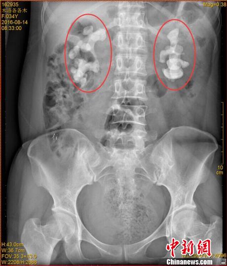 �Ĵ�һŮ�Ӻ���ˮ30�����p�I�L10���׾��ͽYʯ