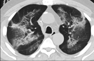 6�����S��CTƽ�߈D���@ʾë����Ӱ׃�錍׃���p�ȽY��Ť����(ͬһ����CTӰ��)